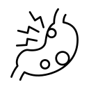 GERD - Gastroesophageal Reflux Disease